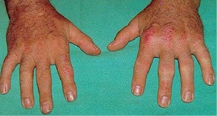 20090202060056-artritis-psoriasica1.jpg